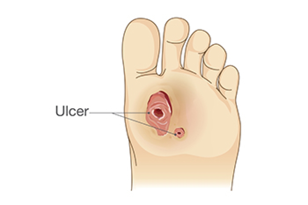 Care of Diabetic Foot Ulcers