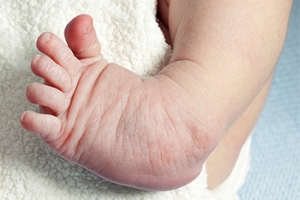 The Definition of Clubfoot