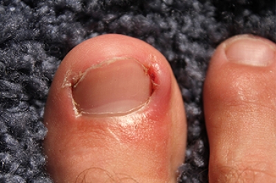 The Importance of  Early Podiatric Care for an Ingrown Toenail