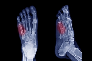 Causes and Treatment of Jones Fractures in Athletes