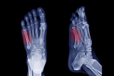 Causes and Treatment of Jones Fractures in Athletes