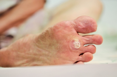 How to Care for Plantar Warts