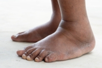 The Connection Between Medical Conditions and Swollen Feet